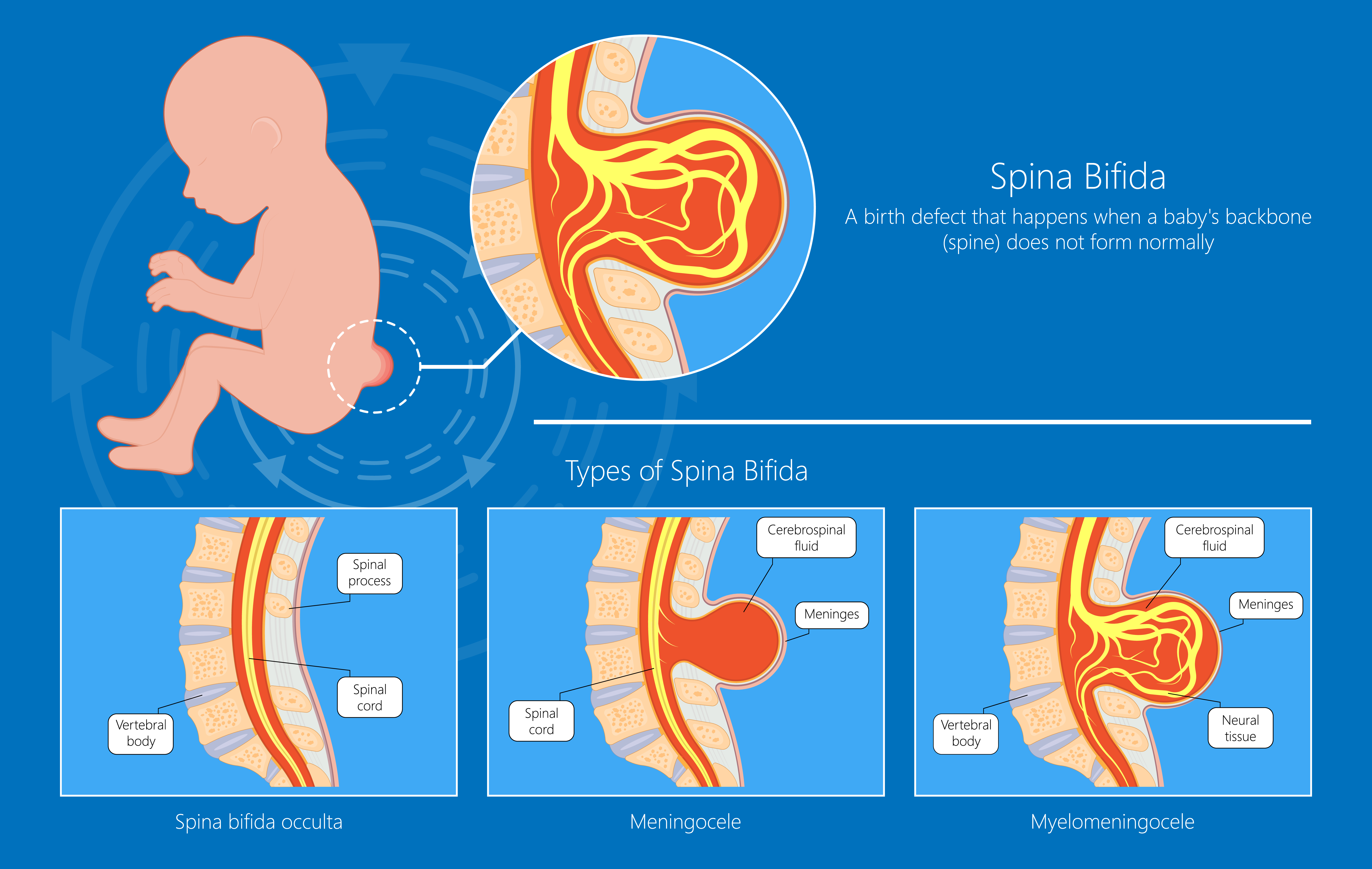 Diagram showing types of Spina Bifida — Spina bifida occulta, Meningocele, and Myelomeningocele. Credit: Reeve Foundation